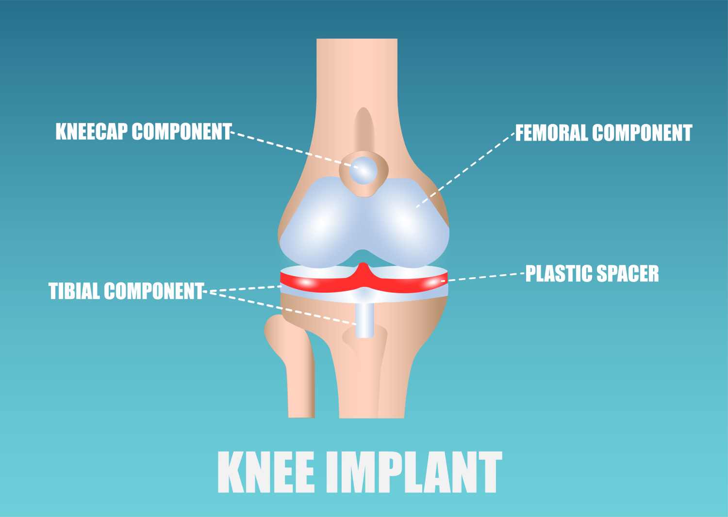 Defective Components of the Recalled Exactech Knee