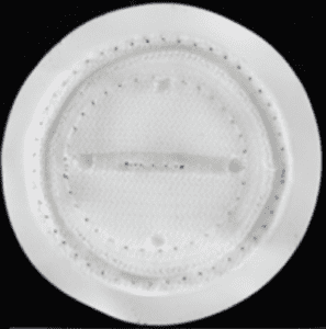 Composix Kugel Recalled Hernia Mesh