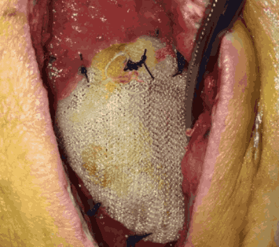 Infected Hernia Mesh Lawsuit