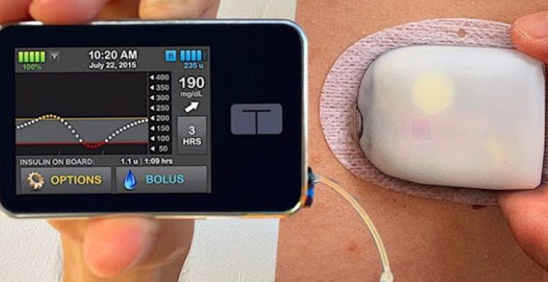 Defective TSlim X2 Insulin Pump Lawsuit