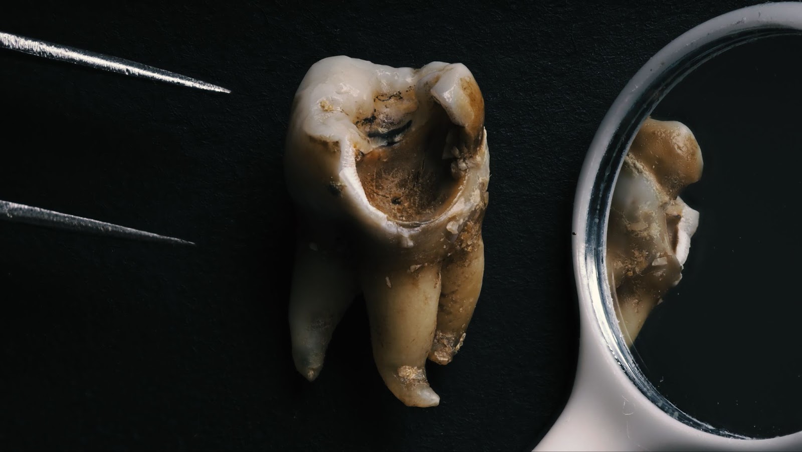 Extracted rotten tooth with a big cavity being examined.  